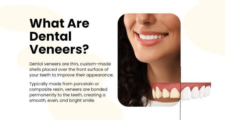 veneers